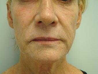 Facelift In A Syringe before 577237