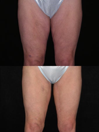 Medial thigh lift before 451944