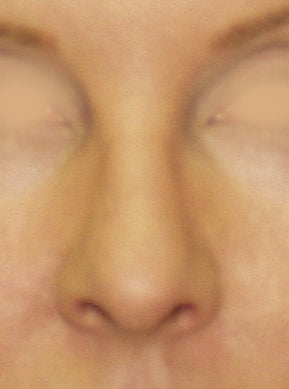 Revision Rhinoplasty after 410624