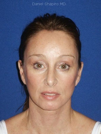 Facelift, Endoscopic Browlift, Upper and Lower Blepharoplasty after 248888