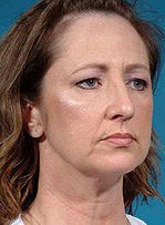 Face/neck/brow lift, upper/lower eyelid surgery before 458805