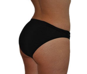 Butt Augmentation (Implants) 550251