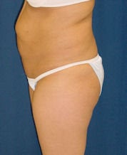 Brazilian Butt Lift 635100