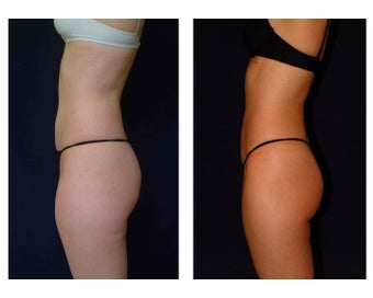 Liposuction before 286689
