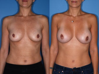 Breast Augmentation - Silicone Implants before 125318