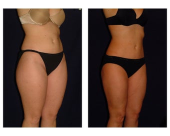 Liposuction before 286642
