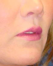 Lip Augmentation with lip lift 99429