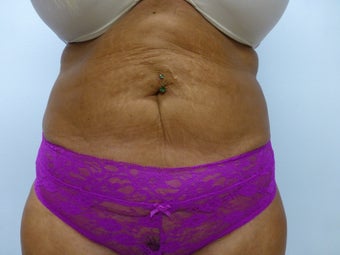 Exilis for skin tightening on post liposuction patient after 590640