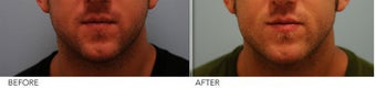 Male Lower Face Enhancement before 339200