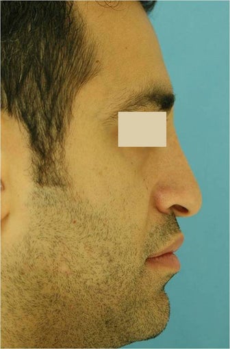 Rhinoplasty, Septoplasty before 125624