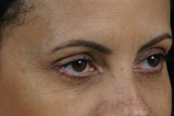 Restylane before 309258
