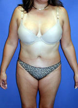 Tummy Tuck (Abdominoplasty) Surgery after 130050