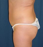 Brazilian Butt Lift before 98185
