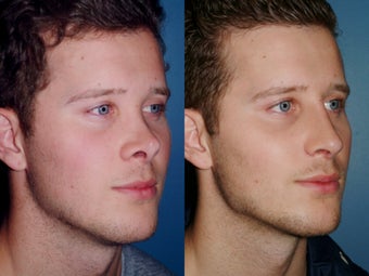 Revision rhinoplasty 334244