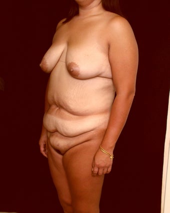 Mommy Makeover before 238724