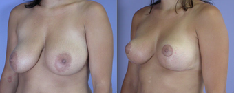 Nipple Surgery before 293282