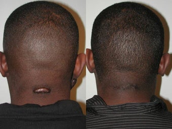 Keloid Excision before 137720