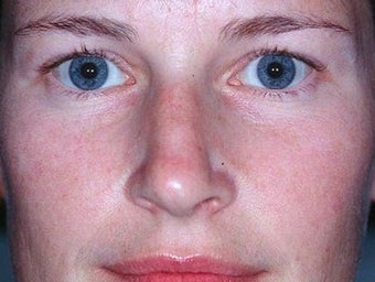 Laser treatment for rosacea after 374539