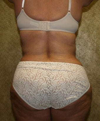 liposuction of abdomen and flanks 582260