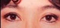 Blepharoplasty after 209324