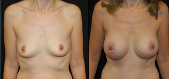 Breast Implants before 150816