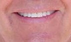 Zoom whitening after 109173