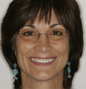 Smile makeover 478964