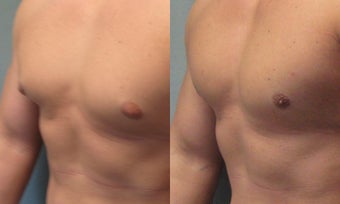 Gynecomastia before 350474