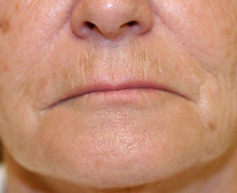 Lip lift, corner of lip lift before 299923