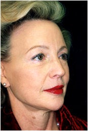 Facelift, Endoscopic Forehead Lift, Quadrilateral Blepharoplasty after 205363