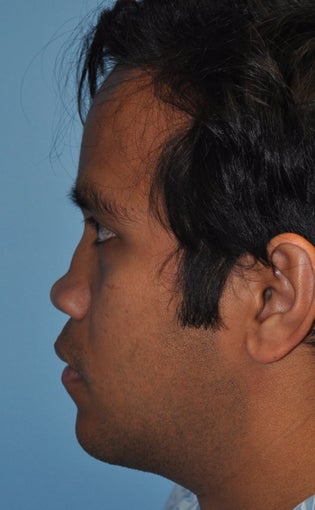 Rhinoplasty-Asian 370618