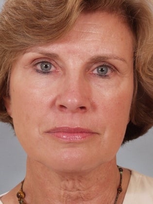 Endoscopic Browlift, Lower Bleph, and Facelift before 633369