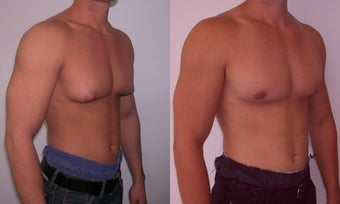 Gynecomastia 341117