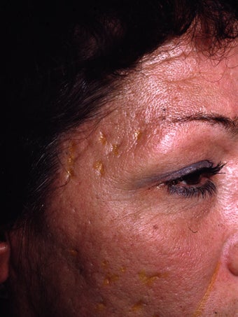 Acne Scarring before 417395