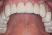 Dental Implants after 510573