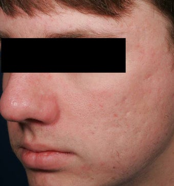 Fraxel -acne scars after 136197