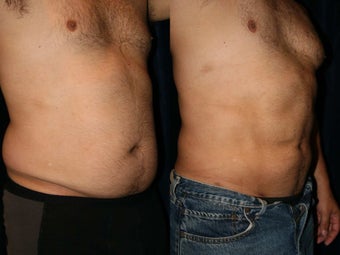 Liposuction 420935
