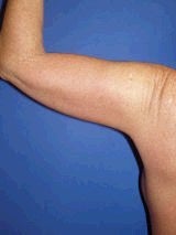 Arm Lift after 356571