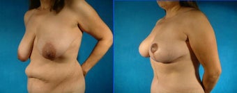 LeJour Breast Lift and Tummy Tuck before 101469