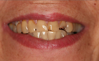 Full Porcelain Crowns before 145684