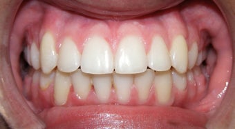 Teen Orthodontic Treatment (case #1BG) after 224559