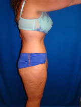 Extended Tummy Tuck, Liposuction, 495158