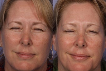 Botox to Crows Feet before 326744