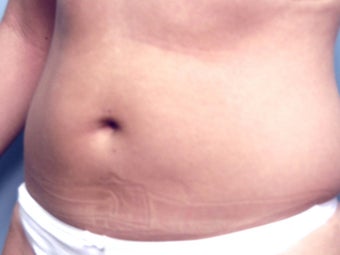 Slim Lipo before 137507