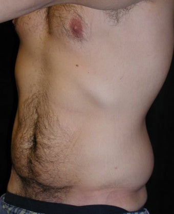 Male tummy Tuck, Flank Liposuction, Male Breast Reduction 578158
