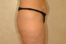 Body Lift before 87349
