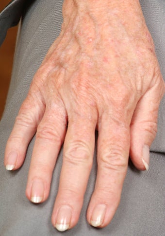 Radiesse treatment for hand rejuvenation before 124648