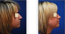 Reduction Rhinoplasty before 88849