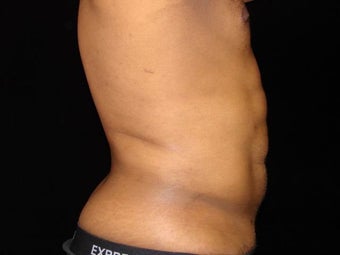 Liposuction of Abdomen, Waist, Flanks, Pecs, with 6 Pack Etching after 203532