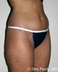 Thigh and Buttock Lift 566621